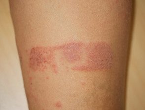 Fenómeno de Koebner en psoriasis debido a dermatitis de contacto con esparadrapo