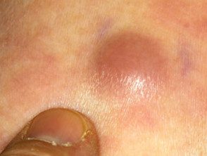 Leucemia cutis