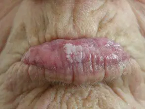 Leucoplasia oral