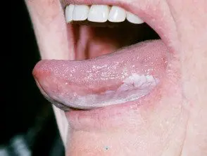 Leucoplasia oral