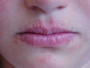 lip-licker-dermatitis-2__protectwyjqcm90zwn0il0_focusfillwzi5ncwymjisingildfd-7865592-5583918