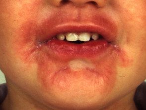 Dermatitis de lamida de labios