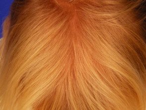 Síndrome del cabello anágeno suelto
