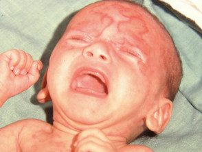 Lupus neonatal