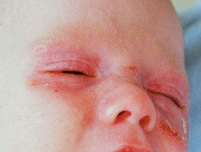 Lupus neonatal