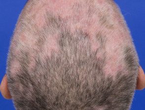   Compromiso del cuero cabelludo en el lupus eritematoso sistémico
