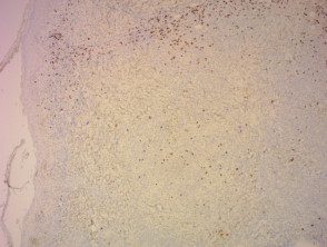 Patología de la papulosis linfomatoide teñida con CD8x40