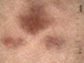 Placa linfoplasmacítica: dermatoscopia