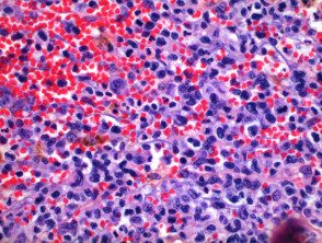 Lyp Pathology of lymphomatoid papulosis. - Hoogstra - Medical Centers