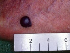 Melanoma nodular