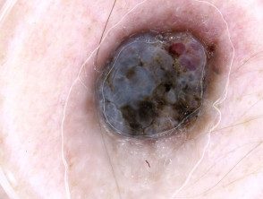 Dermatoscopia del melanoma nodular.