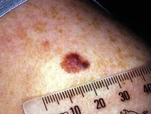 Melanoma de extensión superficial en adolescente