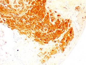 Patología del melanoma foliculotrópico teñida con S100 x100