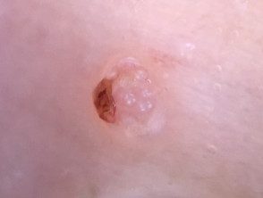 Molusco contagioso