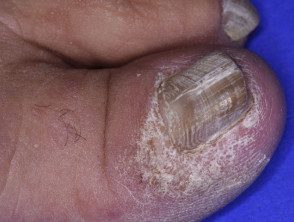 Micosis fungoide que afecta la gran uña del pie