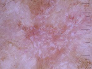 Dermatoscopia de carcinoma nodular de células basales