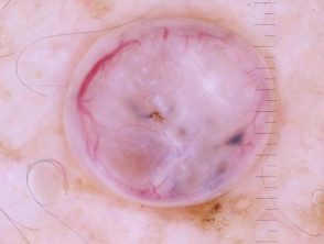 Dermatoscopia polarizada de un carcinoma basocelular nodular que se presenta como un pólipo exofítico