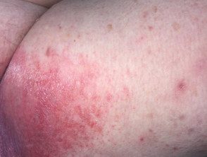 Dermatitis irritante de contacto por orina. Servilleta dermatitis en adultos.
