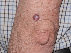 Carcinoma de células basales nodulares, brazo