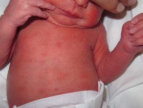 Melanosis pustular neonatal