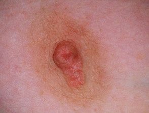 nipple-eczema1__protectwyjqcm90zwn0il0_focusfillwzi5ncwymjisingildfd-8910890-9970810