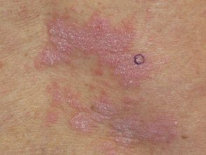 Dermatitis liquenoide inducida por nivolumab
