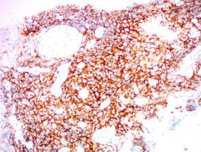 Linfoma natural asesino de células T de tipo nasal teñido con CD56 x200