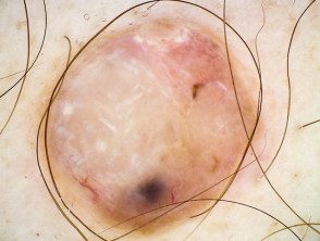 Dermatoscopia melanoma amelanótica nodular