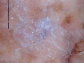 Un melanoma nodular que surge dentro de un melanoma de extensión superficial.