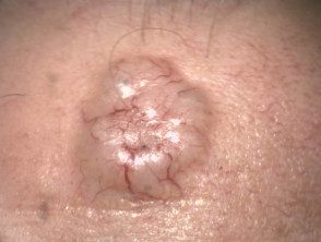 Carcinoma noducístico de células basales