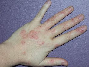 dermatitis de mano