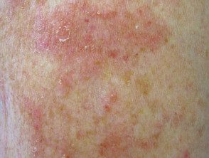 Dermatitis numular en un paciente con anti-TNF
