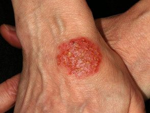 Dermatitis numular, eccema discoide