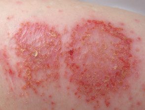 Eczema discoide