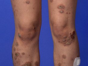 Dermatitis numular, eccema discoide