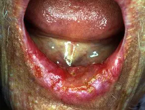 Cáncer oral