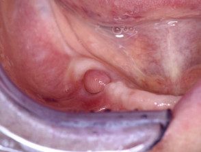 Fibroma oral