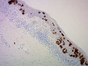CK7 + en infiltración pagetoide de la epidermis por cáncer de mama