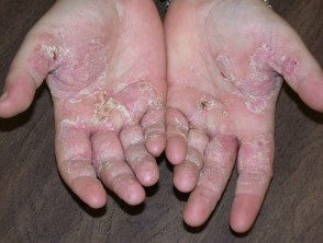 Dermatitis palmar