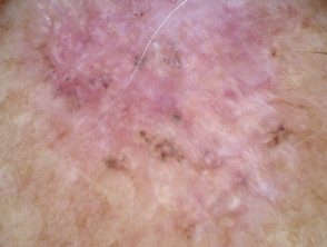 Dermatoscopia de carcinoma basocelular pigmentado