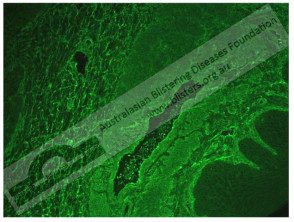Pénfigo foliáceo inmunofluorescencia indirecta