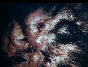 perifolliculitis3__protectwyjqcm90zwn0il0_focusfillwzi5ncwymjisingildfd-5717572-4621602