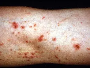 Cortadoras de hilo dermatitis