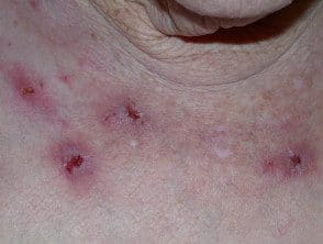 Compulsive Scatching Compulsive skin picking. - Hoogstra - Medical Centers