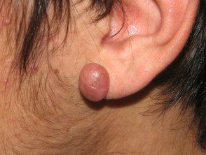 Cicatriz queloide por perforación del oído