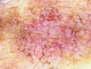 Dermatoscopia de queratosis actínica pigmentada.
