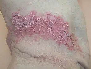 Psoriasis koebnerizada después del herpes zóster