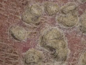 Psoriasis ostraceous