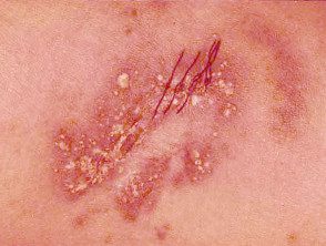 psoriasis pustulosa