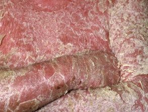 Psoriasis eritrodérmica